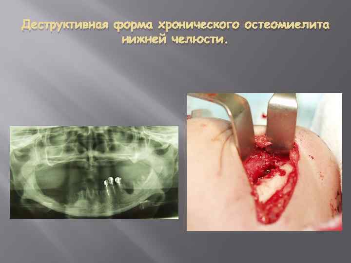 Деструктивная форма хронического остеомиелита нижней челюсти. 