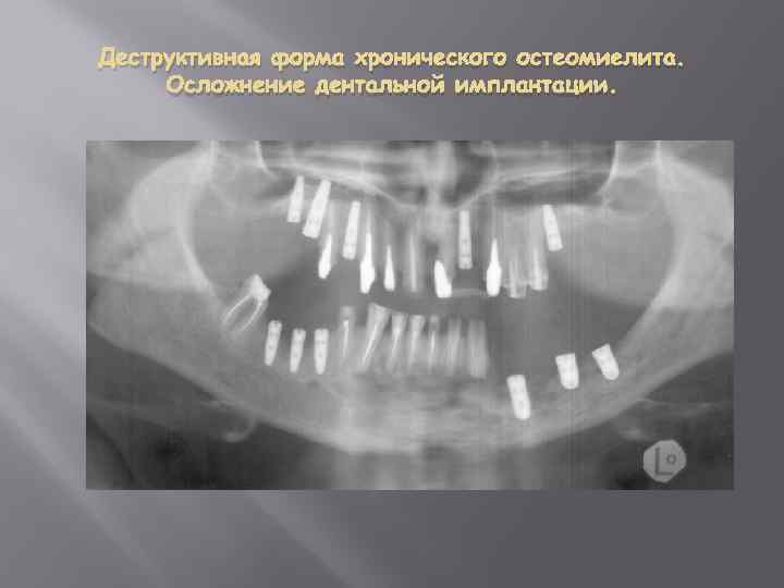 Деструктивная форма хронического остеомиелита. Осложнение дентальной имплантации. 