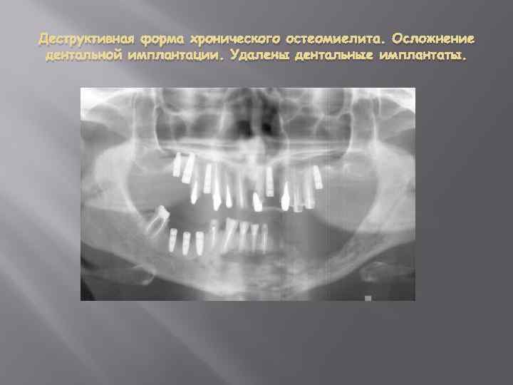 Деструктивная форма хронического остеомиелита. Осложнение дентальной имплантации. Удалены дентальные имплантаты. 