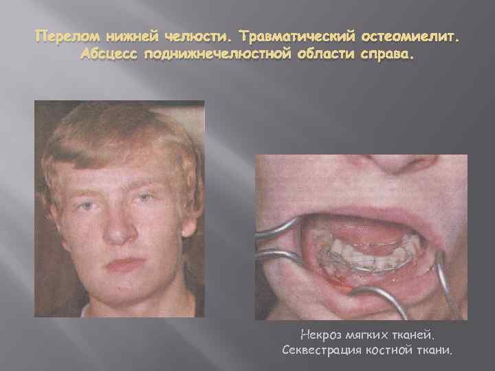 Перелом нижней челюсти. Травматический остеомиелит. Абсцесс поднижнечелюстной области справа. Некроз мягких тканей. Секвестрация костной