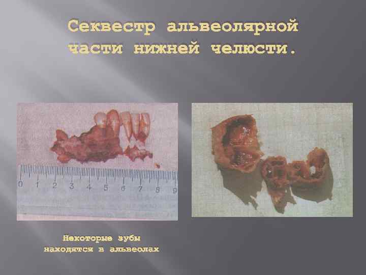 Секвестр альвеолярной части нижней челюсти. Некоторые зубы находятся в альвеолах 