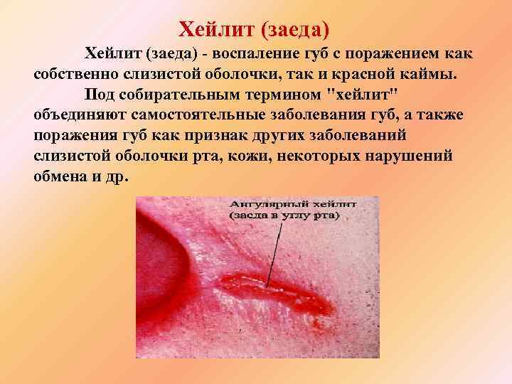 Хейлит (заеда) - воспаление губ с поражением как собственно слизистой оболочки, так и красной