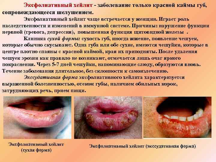 Эксфолиативный хейлит - заболевание только красной каймы губ, сопровождающееся шелушением. Эксфолиативный хейлит чаще встречается