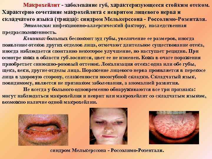 Макрохейлит - заболевание губ, характеризующееся стойким отеком. Характерно сочетание макрохейлита с невритом лицевого нерва