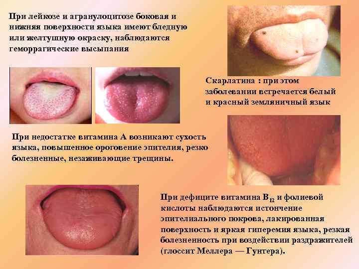 При лейкозе и агранулоцитозе боковая и нижняя поверхности языка имеют бледную или желтушную окраску,
