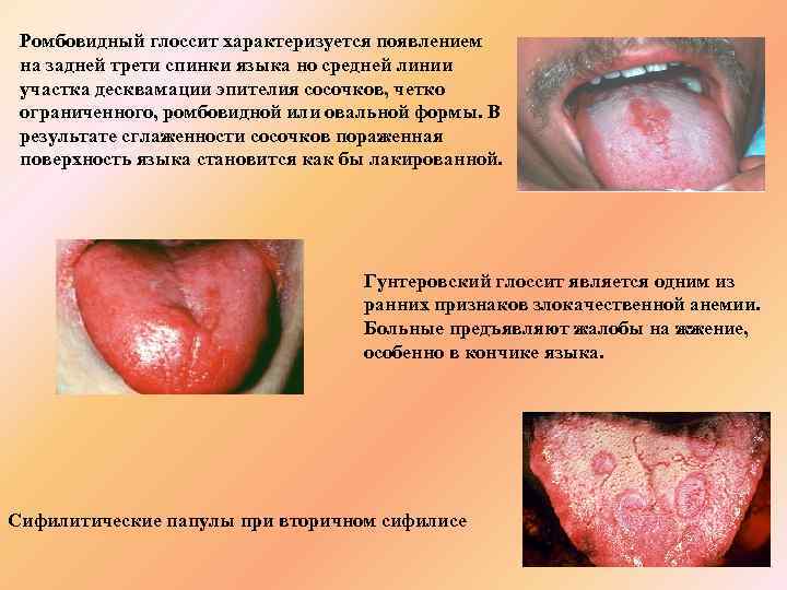 Ромбовидный глоссит характеризуется появлением на задней трети спинки языка но средней линии участка десквамации