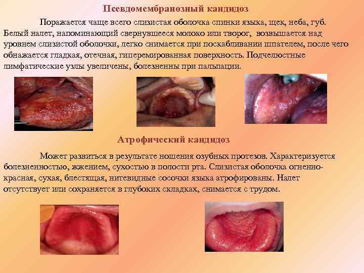 Псевдомембранозный кандидоз Поражается чаще всего слизистая оболочка спинки языка, щек, неба, губ. Белый налет,