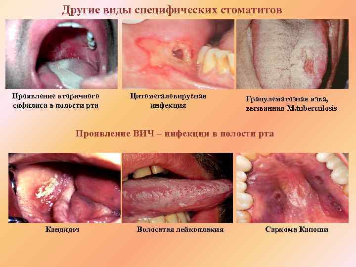 Другие виды специфических стоматитов Проявление вторичного сифилиса в полости рта Цитомегаловирусная инфекция Гранулематозная язва,
