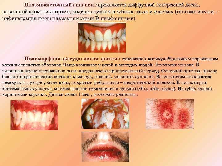 Плазмоклеточный гингивит проявляется диффузной гиперемией десен, вызванной ароматизаторами, содержащимися в зубных пасах и жвачках