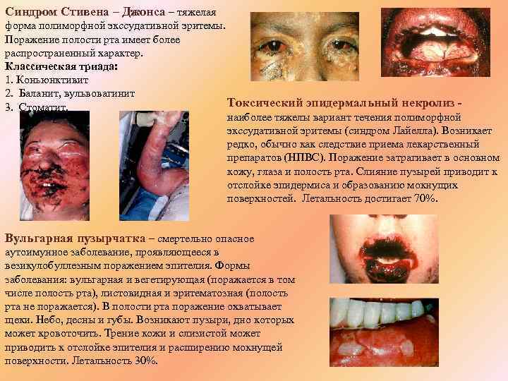 Синдром Стивена – Джонса – тяжелая форма полиморфной экссудативной эритемы. Поражение полости рта имеет