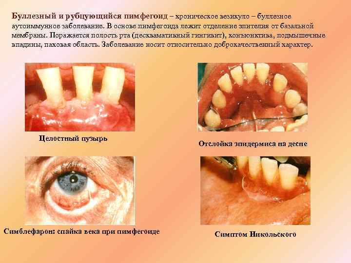 Буллезный и рубцующийся пимфегоид – хроническое везикуло – буллезное аутоиммунное заболевание. В основе пимфегоида