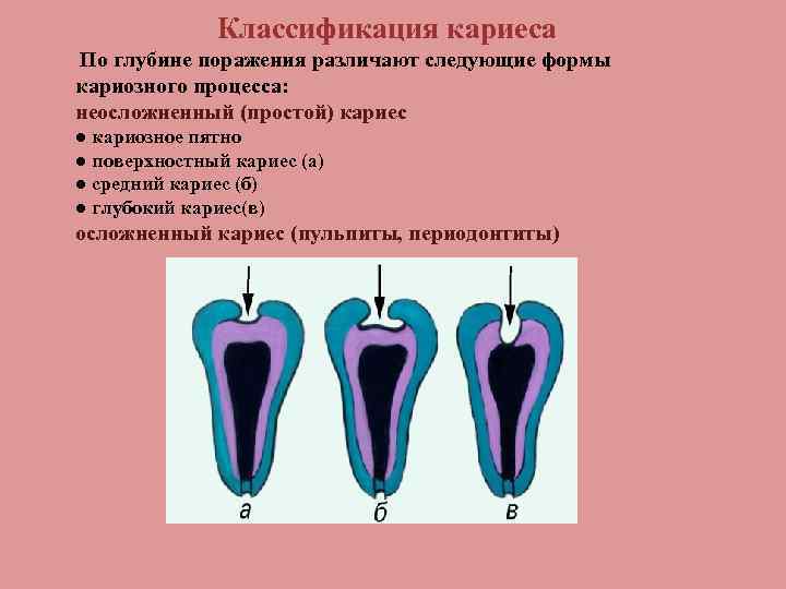 Классификация кариеса По глубине поражения различают следующие формы кариозного процесса: неосложненный (простой) кариес ●