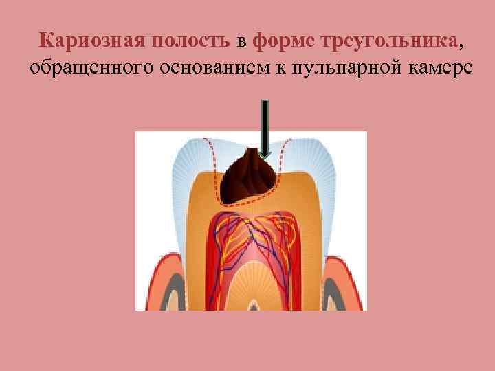 Форма кариозной полости. Строение кариозной полости. Глубокая кариозная полость схема. Полость треугольной формы.