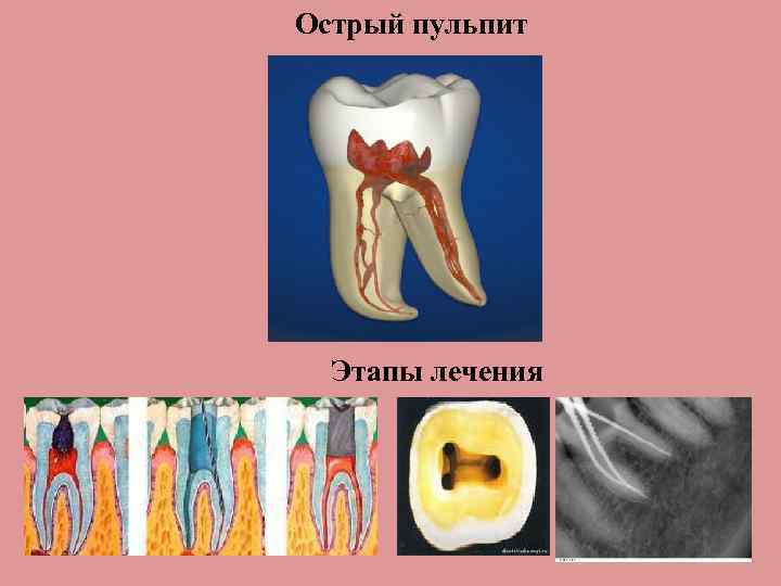 Острый пульпит Этапы лечения 