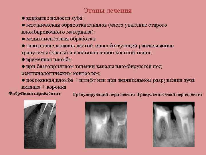 Этапы лечения ● вскрытие полости зуба; ● механическая обработка каналов (часто удаление старого пломбировочного