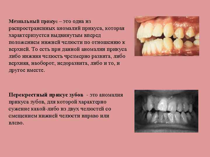 Мезиальный прикус презентация