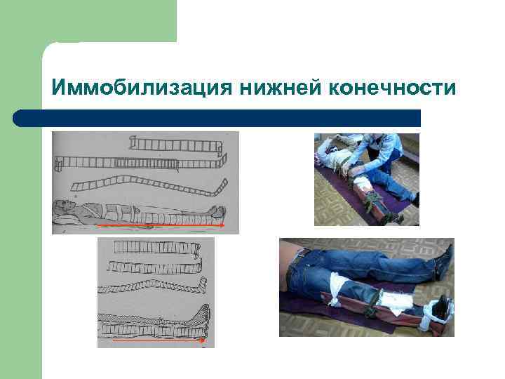 Иммобилизация нижней конечности 