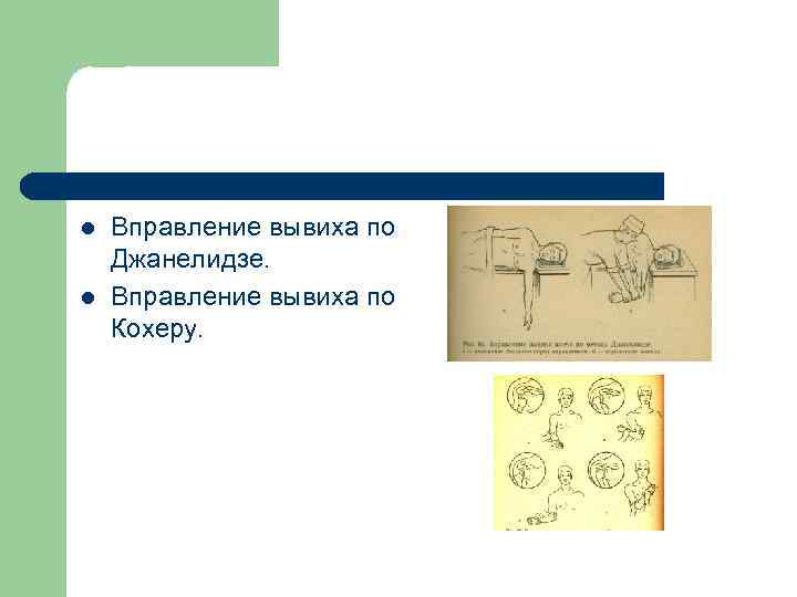 l l Вправление вывиха по Джанелидзе. Вправление вывиха по Кохеру. 