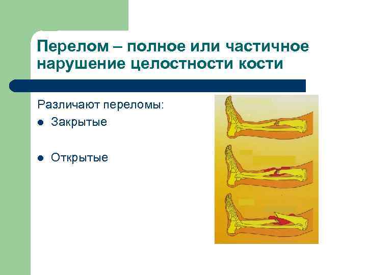 Перелом – полное или частичное нарушение целостности кости Различают переломы: l Закрытые l Открытые