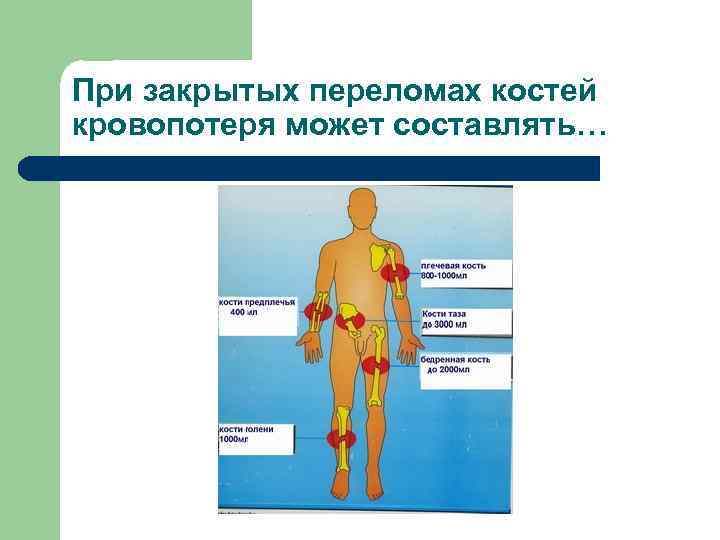 При закрытых переломах костей кровопотеря может составлять… l 