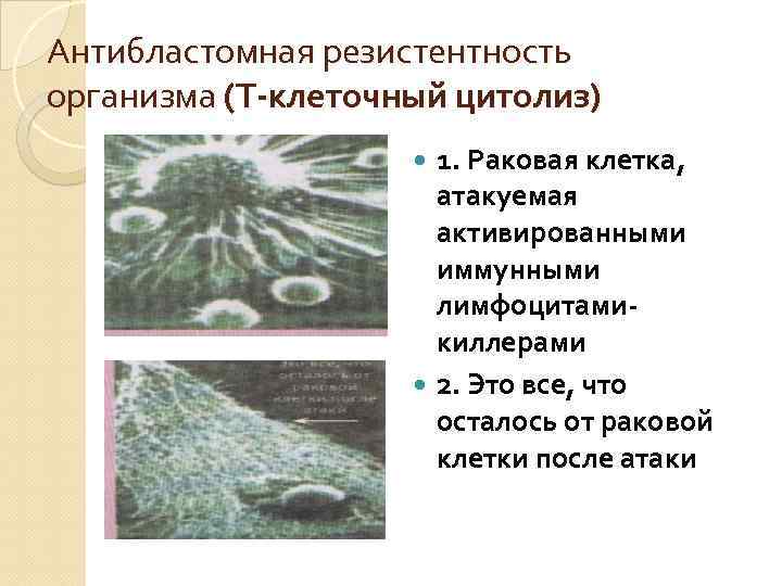 Антибластомная резистентность организма (Т-клеточный цитолиз) 1. Раковая клетка, атакуемая активированными иммунными лимфоцитамикиллерами 2. Это