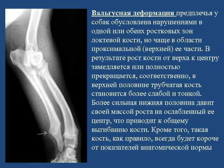 Вальгусная деформация предплечья у собак обусловлена нарушениями в одной или обеих ростковых зон локтевой