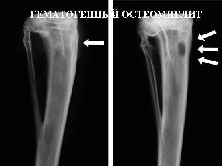 Хронический остеомиелит картинки