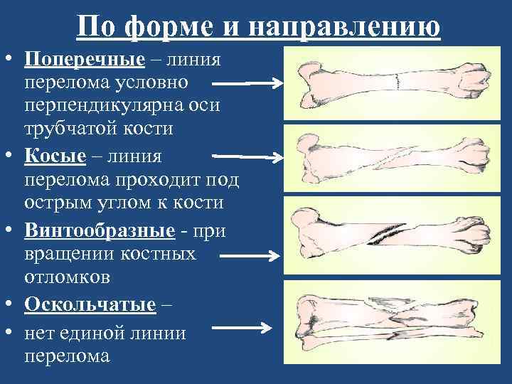 По форме и направлению • Поперечные – линия перелома условно перпендикулярна оси трубчатой кости