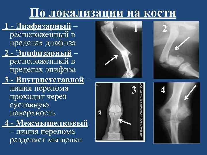 Дистальные переломы бедренной кости