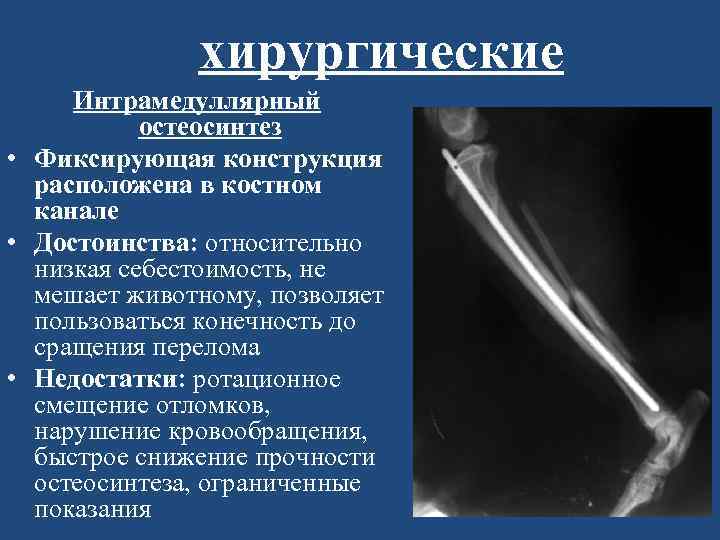 хирургические Интрамедуллярный остеосинтез • Фиксирующая конструкция расположена в костном канале • Достоинства: относительно низкая