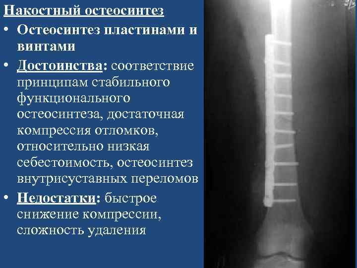 Накостный остеосинтез. Экстрамедуллярный остеосинтез экстрамедуллярный. Экстрамедуллярный (накостный) остеосинтез. Накостный остеосинтез пластинами. Интрамедуллярный остеосинтез преимущества.