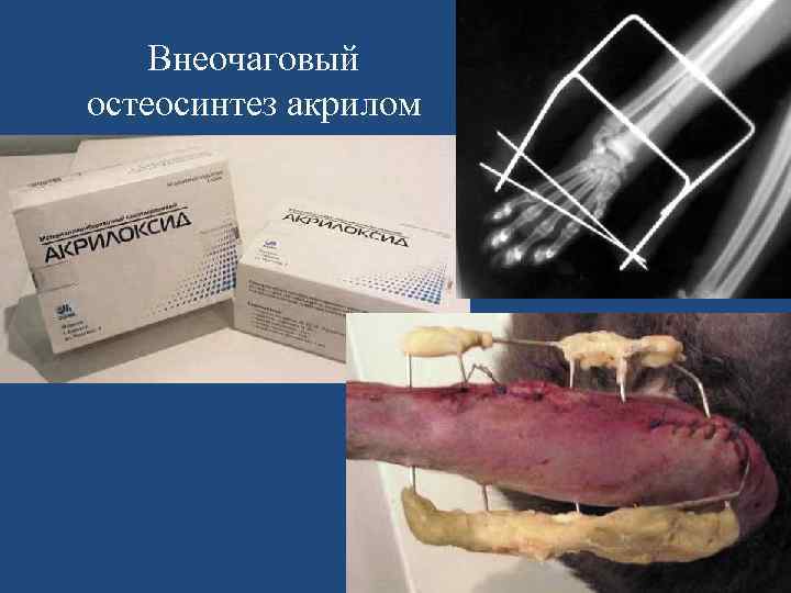 Внеочаговый остеосинтез акрилом 