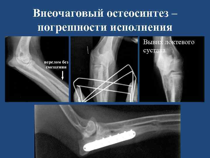Внеочаговый остеосинтез – погрешности исполнения Вывих локтевого сустава 
