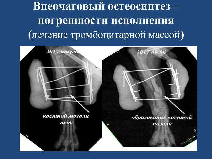 Внеочаговый остеосинтез – погрешности исполнения (лечение тромбоцитарной массой) 