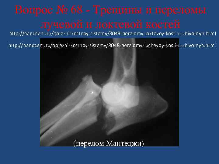 Вопрос № 68 - Трещины и переломы лучевой и локтевой костей http: //handcent. ru/bolezni-kostnoy-sistemy/3049