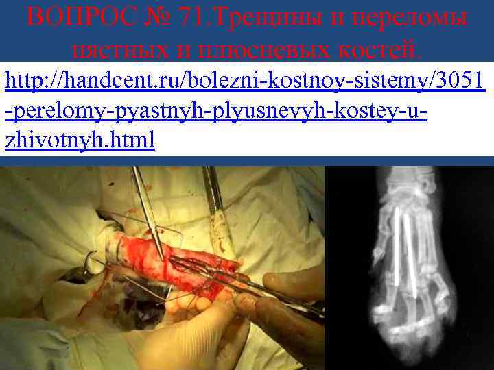 ВОПРОС № 71. Трещины и переломы пястных и плюсневых костей. http: //handcent. ru/bolezni-kostnoy-sistemy/3051 -perelomy-pyastnyh-plyusnevyh-kostey-uzhivotnyh.
