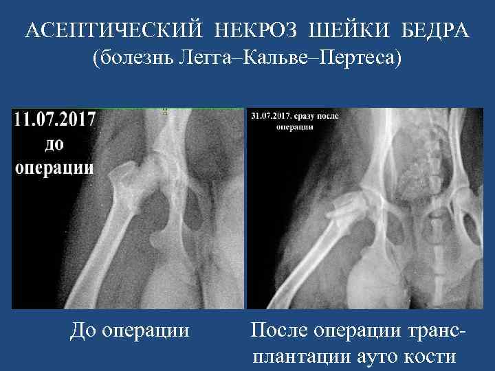 АСЕПТИЧЕСКИЙ НЕКРОЗ ШЕЙКИ БЕДРА (болезнь Легга–Кальве–Пертеса) До операции После операции транс плантации ауто кости