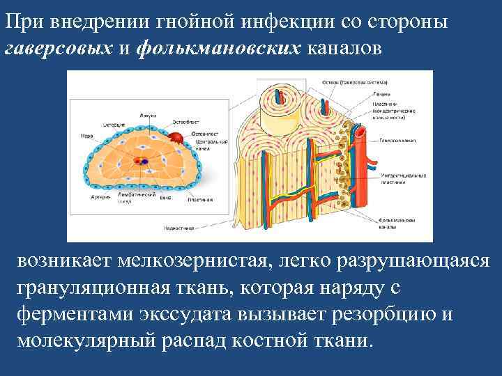 При внедрении гнойной инфекции со стороны гаверсовых и фолькмановских каналов возникает мелкозернистая, легко разрушающаяся