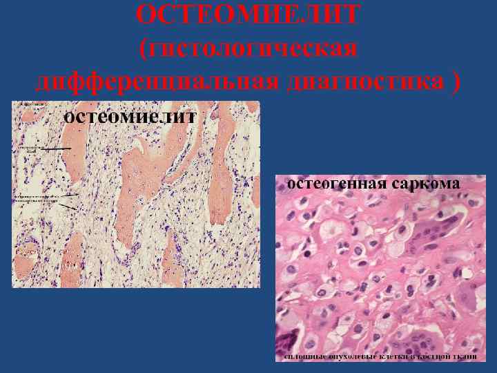 ОСТЕОМИЕЛИТ (гистологическая дифференциальная диагностика ) 