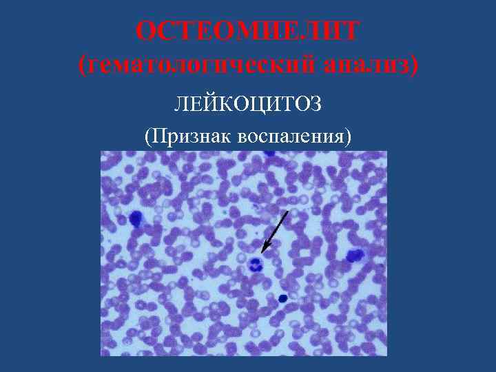 ОСТЕОМИЕЛИТ (гематологический анализ) ЛЕЙКОЦИТОЗ (Признак воспаления) 