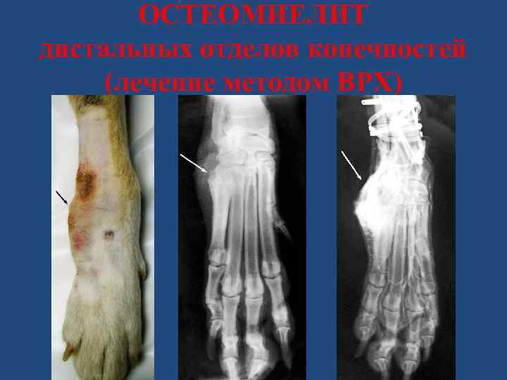 ОСТЕОМИЕЛИТ дистальных отделов конечностей (лечение методом ВРХ) 