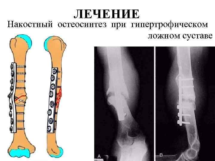 ЛЕЧЕНИЕ Накостный остеосинтез при гипертрофическом ложном суставе 