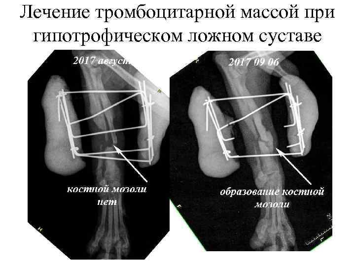 Лечение тромбоцитарной массой при гипотрофическом ложном суставе 