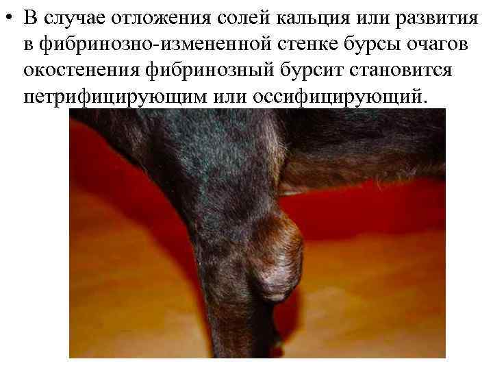  • В случае отложения солей кальция или развития в фибринозно-измененной стенке бурсы очагов