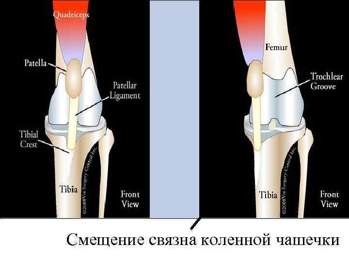 Смещение связна коленной чашечки 