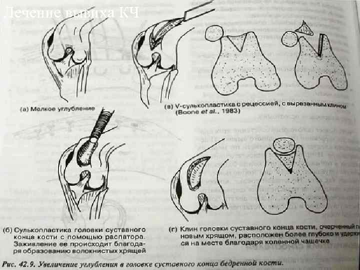 Лечение вывиха КЧ 