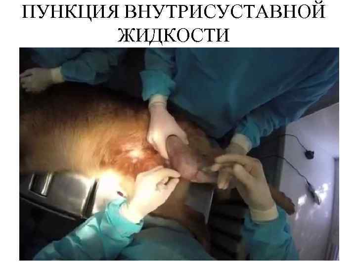 ПУНКЦИЯ ВНУТРИСУСТАВНОЙ ЖИДКОСТИ 