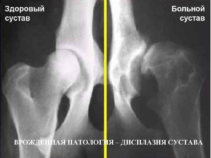ВРОЖДЕННАЯ ПАТОЛОГИЯ – ДИСПЛАЗИЯ СУСТАВА 