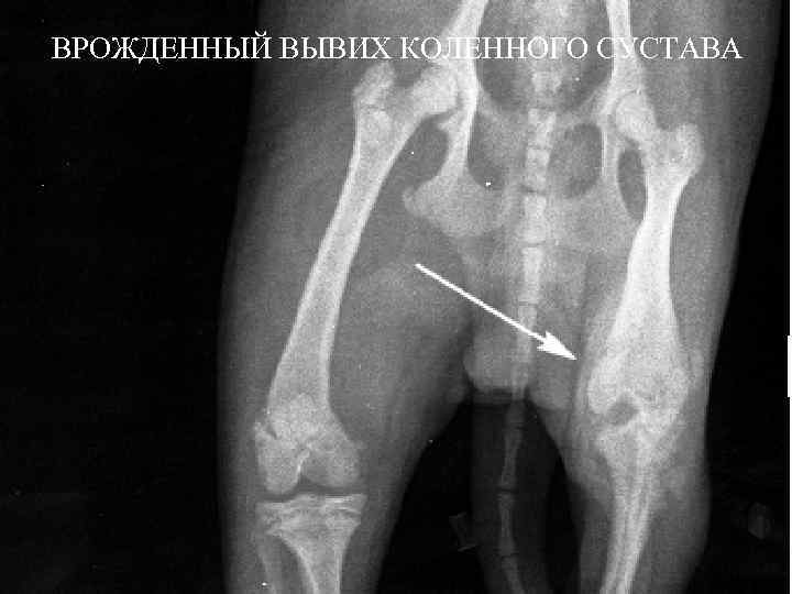 ВРОЖДЕННЫЙ ВЫВИХ КОЛЕННОГО СУСТАВА 