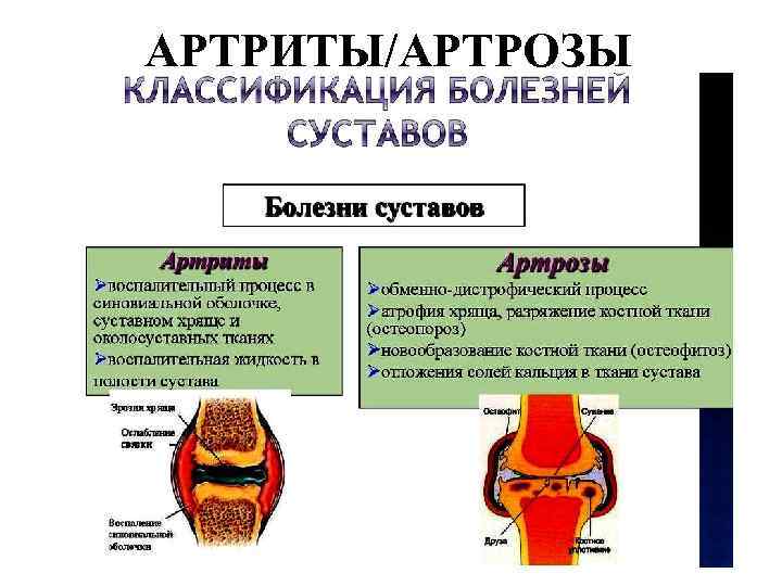 АРТРИТЫ/АРТРОЗЫ 